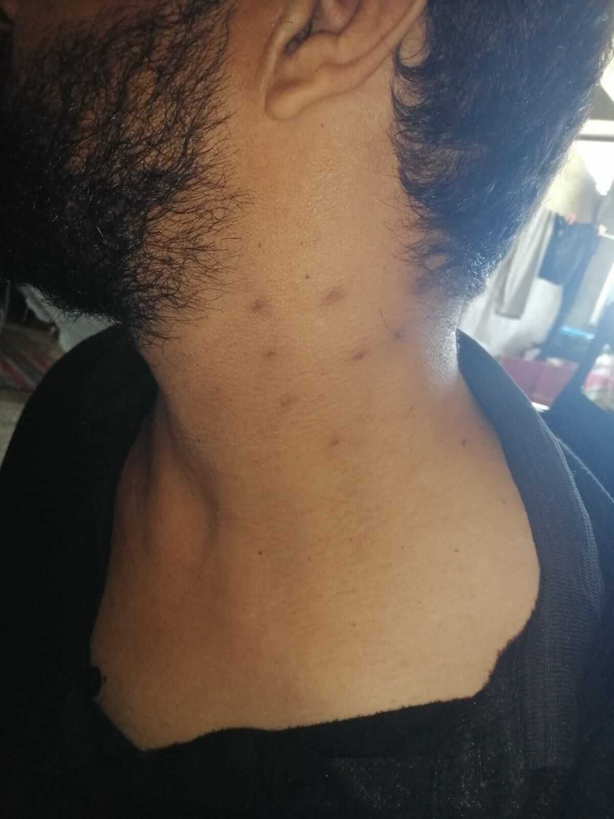 آثار صعق على رقبة عيسى